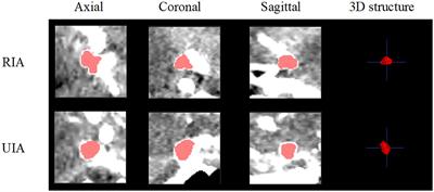 Automatic risk prediction of intracranial aneurysm on CTA image with convolutional neural networks and radiomics analysis